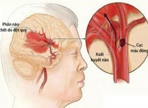 Phương pháp điều trị cục máu đông trong não an toàn hiệu quả tránh gây biến chứng